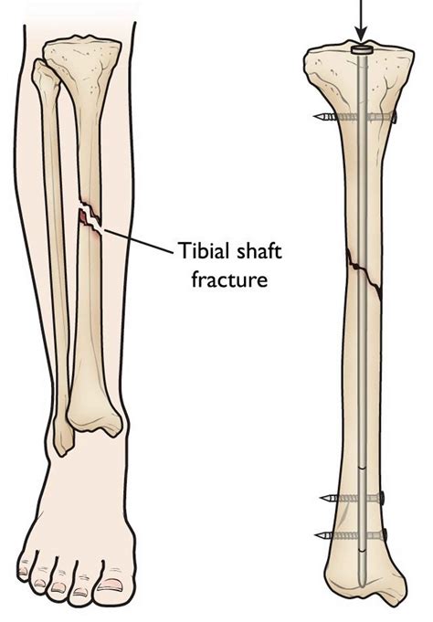 Tibial Shaft Fracture Causes Types Symptoms Diagnosis