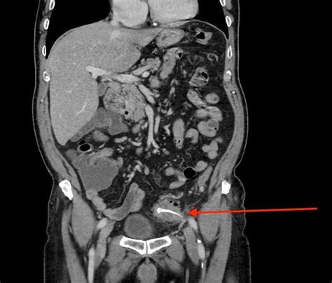 Contrast Enhanced Ct Scan Of Abdomen With Coronal Reconstruction Shows
