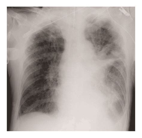 A Chest X Ray Days After Admission Revealed The Progression Of Download Scientific Diagram