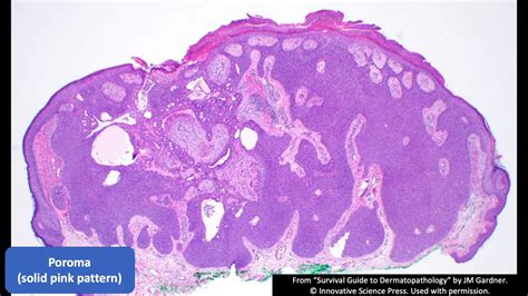 Sweat Gland Tumors Solid Pink Pattern Poroma Hidradenoma