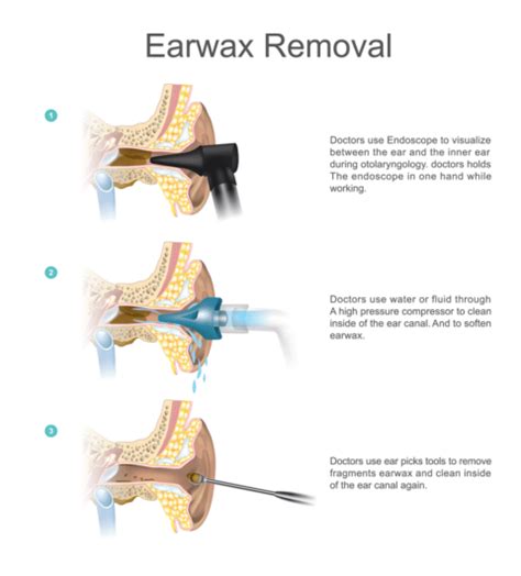 Earwax What You Need To Know Salem Audiology