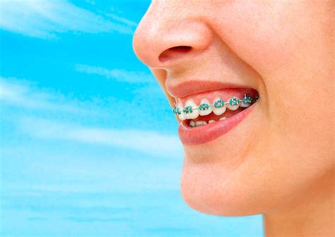 Cuidar Tu Ortodoncia En Verano Clínica Dental Gardents