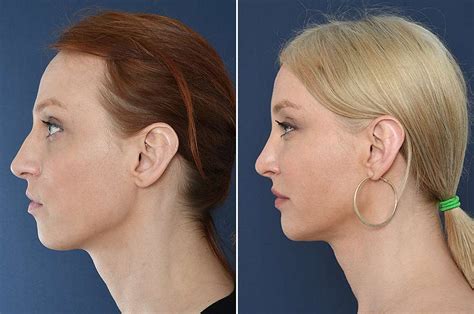 Cleft Chin Removal Before And After