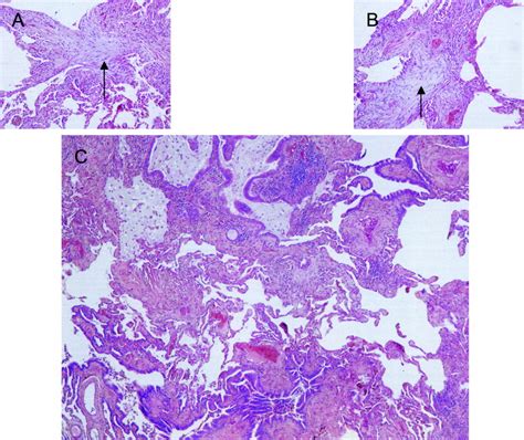 Microscopic Polyangiitis Presenting As A Pulmonary‐muscle Syndrome