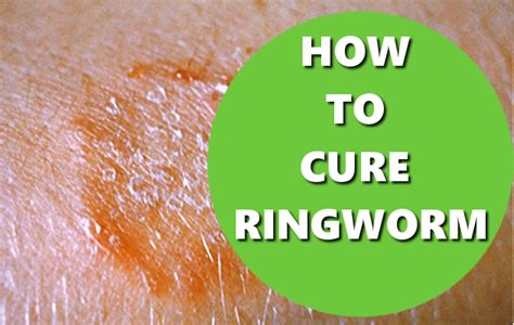 How To Cure Ringworm Basic How Tos