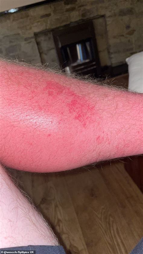 Baked Brits Share Snaps Of Red Skin And Awkward Tan Lines After Getting