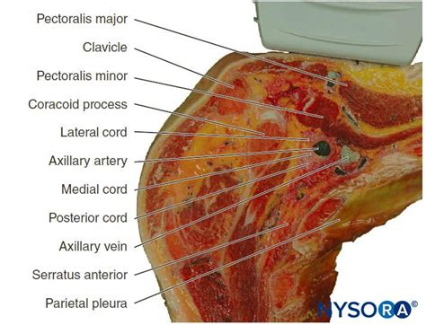 Ultrasound Guided Infraclavicular Brachial Plexus Block Nysora