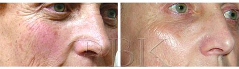 Clearlift Facial Rejuvenation Drbk Aesthetics Clinic In Reading