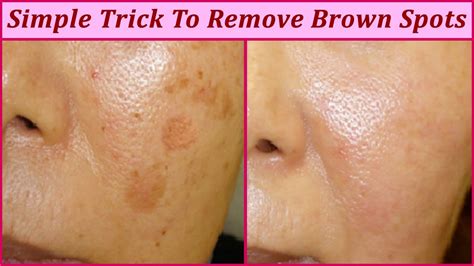 Simple Trick To Remove Brown Spots From Your Skin Beauty4everything3