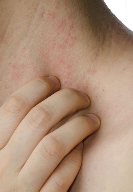 Eczema Symptoms Causes Treatments Types Triggers