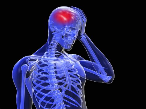 Causas de una trombosis hemorroidal. Embolia Cerebral: Qué es, síntomas, causas, secuelas y más