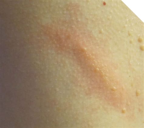 Photos Of Poison Ivy Rashes Poison Ivy Cures Help And Information