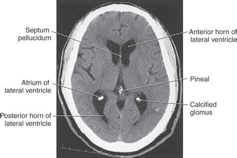 The Ventricles Choroid Plexus And Cerebrospinal Fluid Neupsy Key