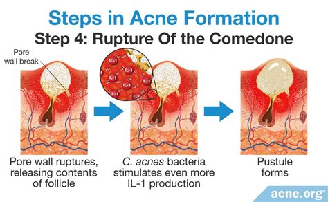 Scientists Now Believe Acne Is Primarily Inflammatory