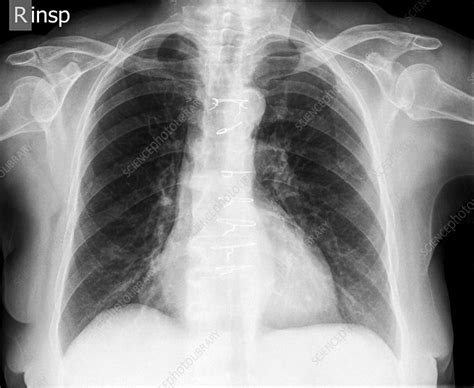 Normal Chest X Ray Stock Image C019 7404 Science Photo Library