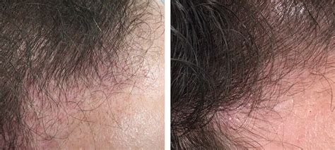 Platelet Rich Plasma Therapy Before And After Kingsway Dermatology