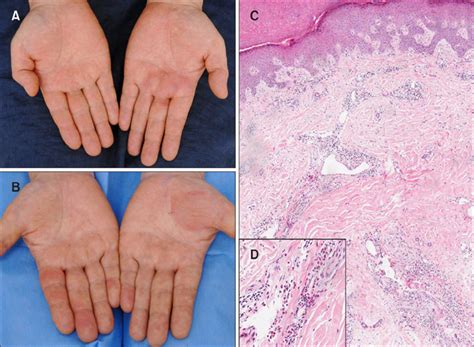 Eosinophilic Annular Erythema Localized To The Palms And The Soles