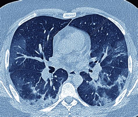 Lungs Affected By Covid 19 Pneumonia Axial Ct Scan Stock Image