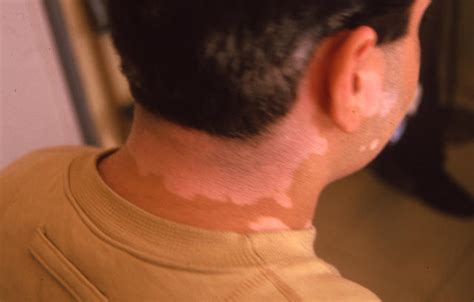 Pigmentation Disorders Vitiligo Picture Hellenic Dermatological