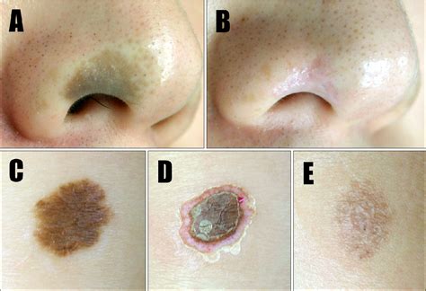 Figure 1 From Effective Treatment Of Congenital Melanocytic Nevus And