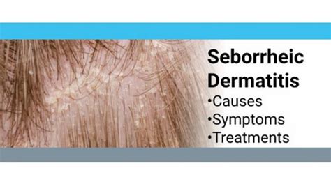 Seborrheic Dermatitis Info And Treatment —