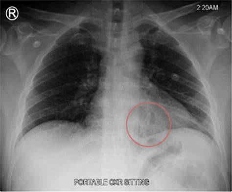 A Chest Radiograph Showed A Small Air Pocket In The Paraspinal Space
