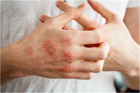 Eczema Vs Psoriasis Whats The Difference Cxbco Ordination