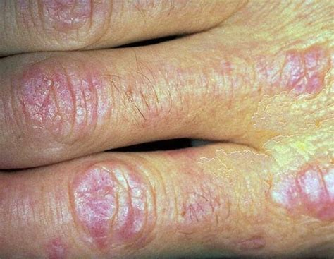 Dermatomyositis Pictures Symptoms Treatment Diagnosis Causes