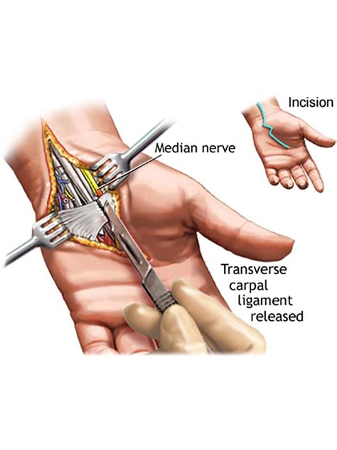 Nerve Surgery And Treatments Tyler Neurosurgical Associates