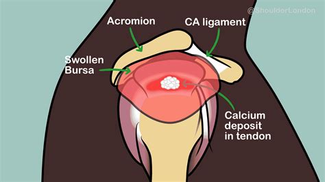 Shoulder Calcification