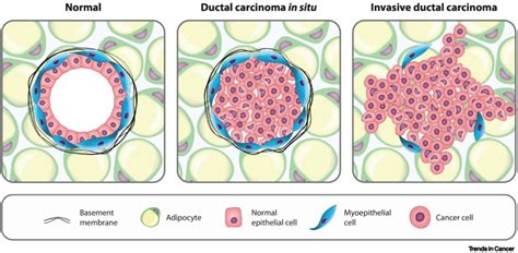 Everybody Needs Good Neighbours The Progressive Dcis Microenvironment