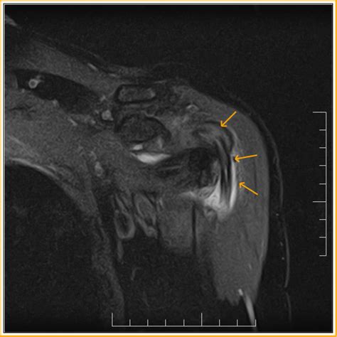 Dislocation of the long head of biceps tendon is a common shoulder injury. Long Head Biceps Tear-MRI - Sumer's Radiology Blog