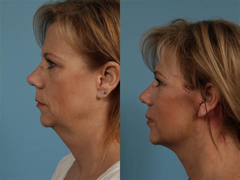 Neck Lift Before & After Photos Patient 275 | Chicago, IL ...