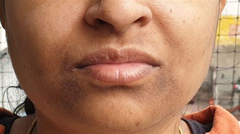 Vitiligo On The Lips Pictures
