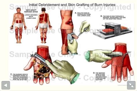 Debridement And Use Of Skin Grafts Skin Grafting Nursing Notes