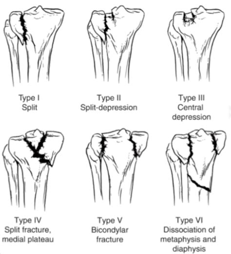 Clasificación De Las Fracturas De Meseta Tibial Con Rx Awaredoctor