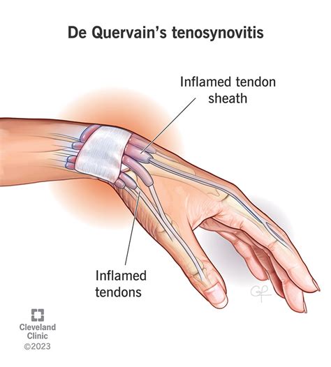 Tenosynovitis De Quervain S Causes Symptoms Treatment Tenosynovitis