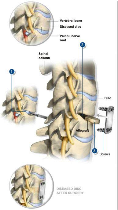 Pin On Surgical Procedures At Southeastern Spine