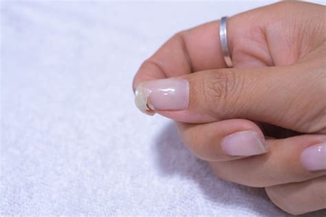 Nail Problems Due To Vitamin Deficiency Mighty Goodness