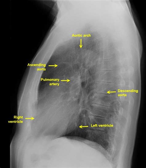 Lateral Chest Radiograph Anatomy