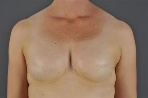 Fight To Know Your Options For Breast Reconstruction Mark Jewell MD