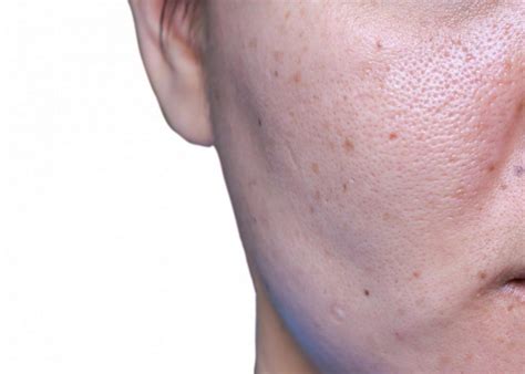 Laser Contraction Of The Pores On The Face Dr Shef