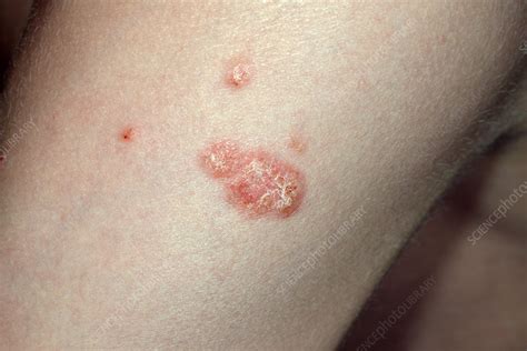Guttate Psoriasis Stock Image C0263399 Science Photo Library