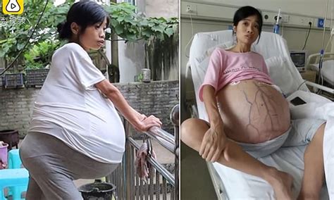 Chinese Mother Of Two Whose Belly Ballooned By 88 Pounds Due To Ovarian