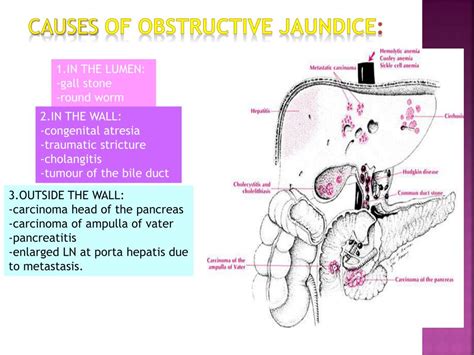 Ppt Obstructive Jaundice Powerpoint Presentation Free Download Id