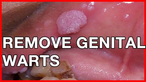 ways to remove genital warts in men youtube