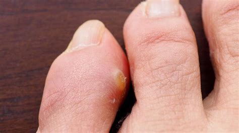 Treatment Of Corns Between Toes Active Care Podiatry