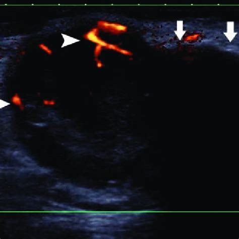 Ultrasound Of The Groins Showing Enlarged Inguinal Lymph Nodes With The Best Porn Website
