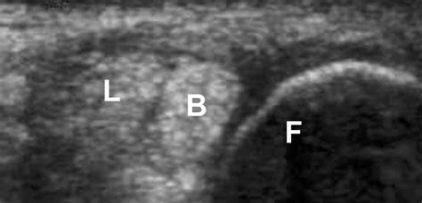 Dynamic Sonographic Evaluation Of Peroneal Tendon Subluxation Ajr