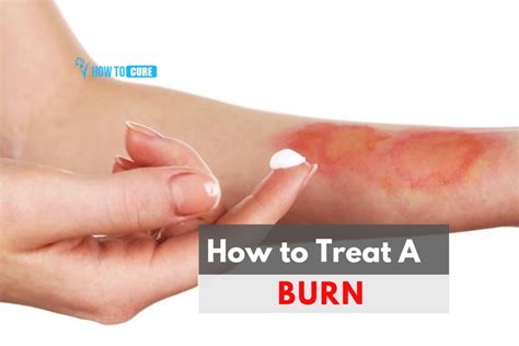 How To Treat A Burn Super Effective Ways